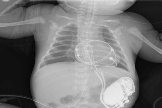  Новорожденному имплантировали электрокардиостимулятор сердца